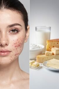 Milk, IGF-1 and insulin pathways associated with acne development